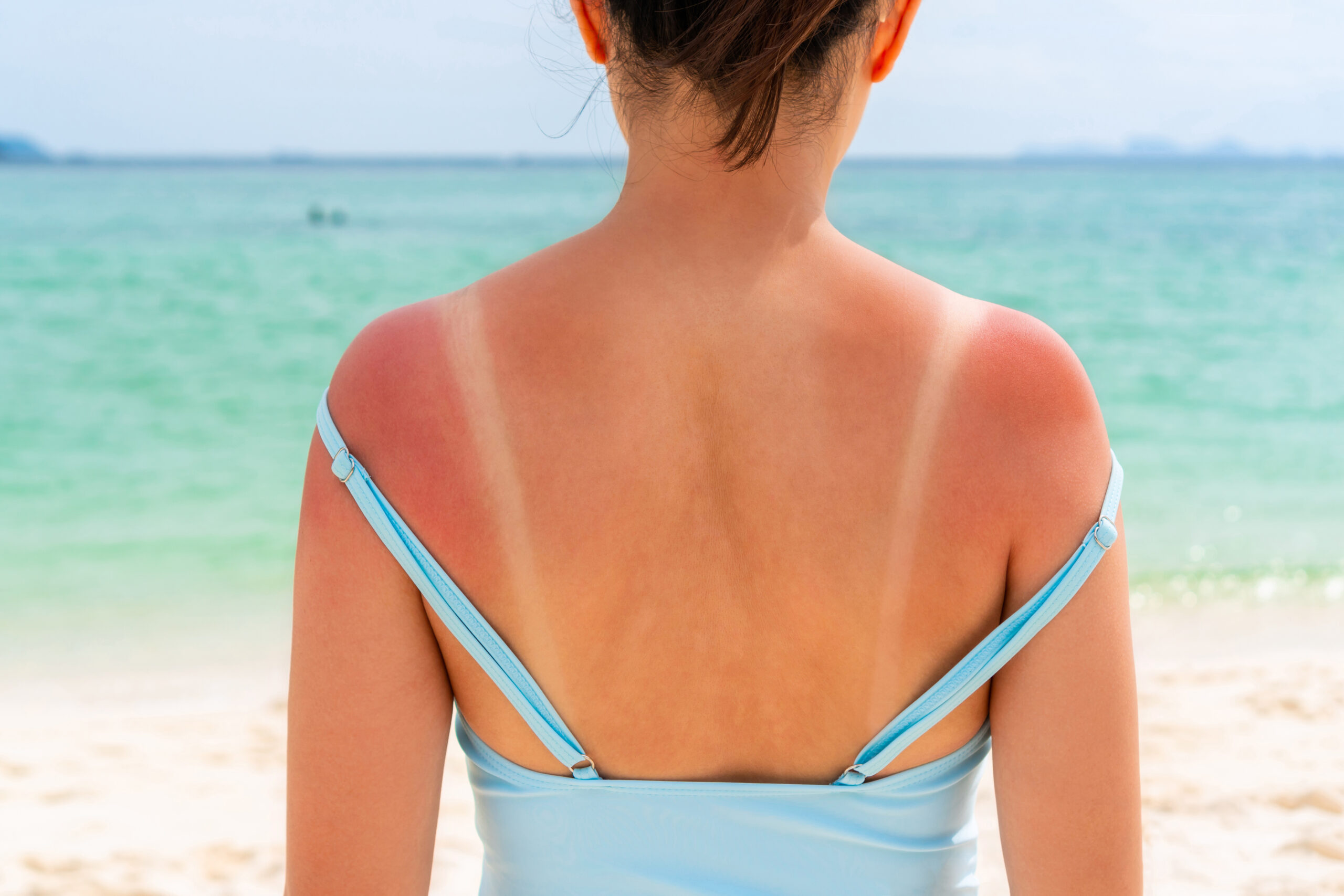 Sonnenschutzmittel im VKI-Test: 5x “Nicht genügend” für UV-Schutz