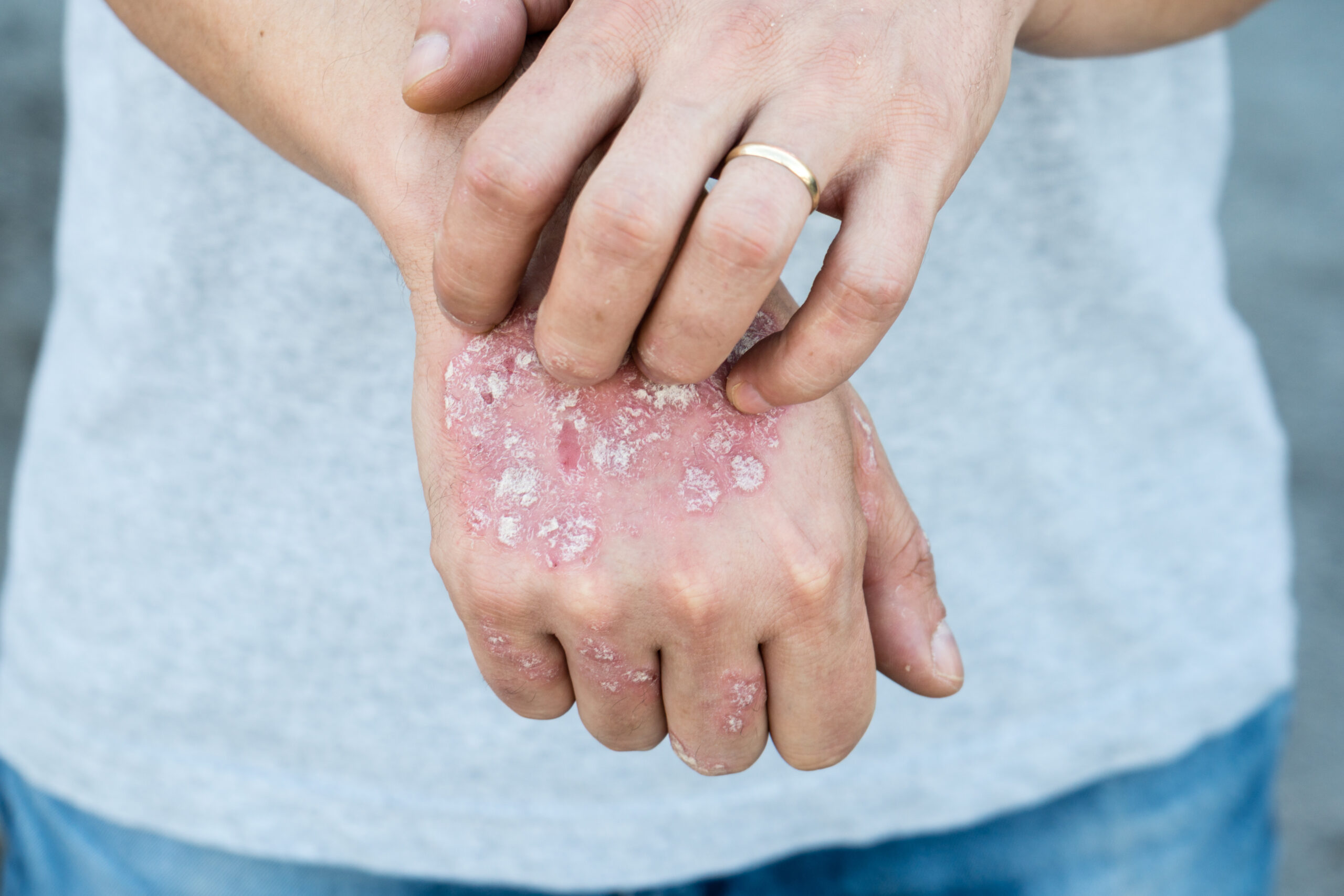 Studie: Stress kann Psoriasis-Schübe direkt auslösen