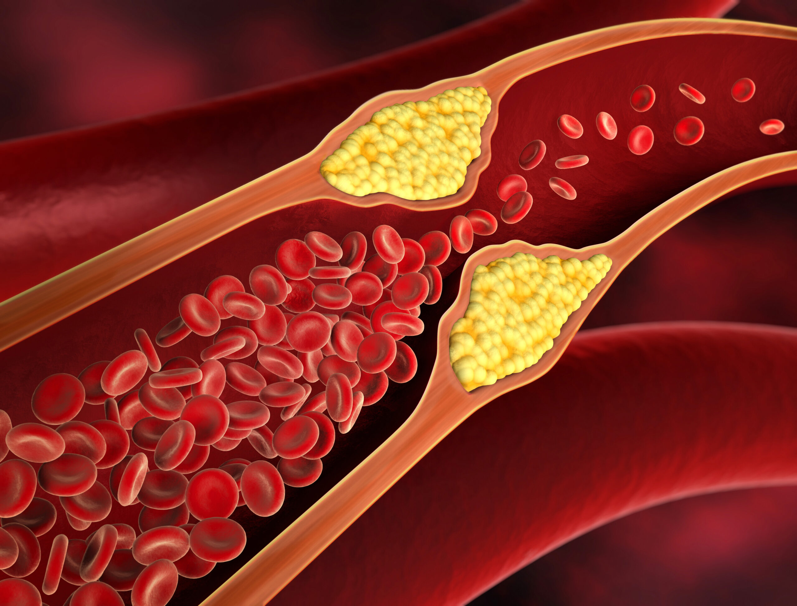 Unentdeckte Hypercholesterinämie bei Kindern