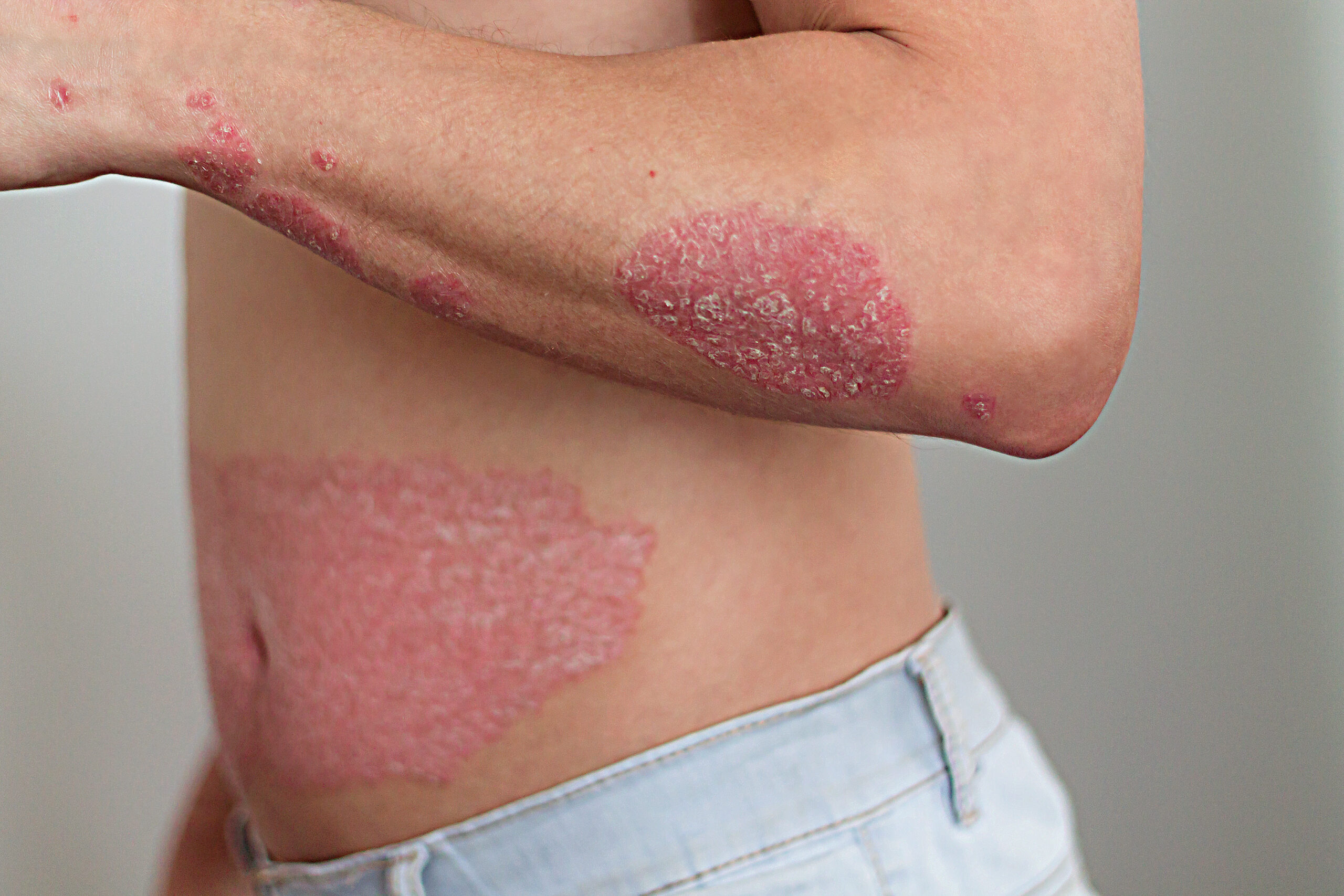 Psoriasis: Neue Behandlungsmöglichkeit